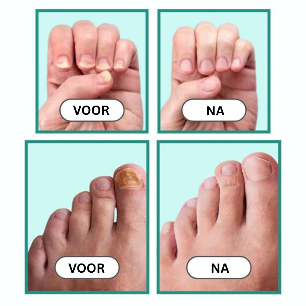 Gezonde Nagels Apparaat
